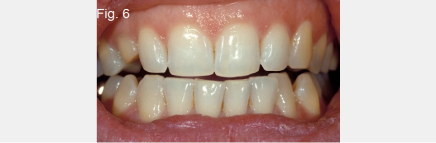 A Guide to Anterior Open Bites FrankSpear AnteriorOpenBites Fig.6A
