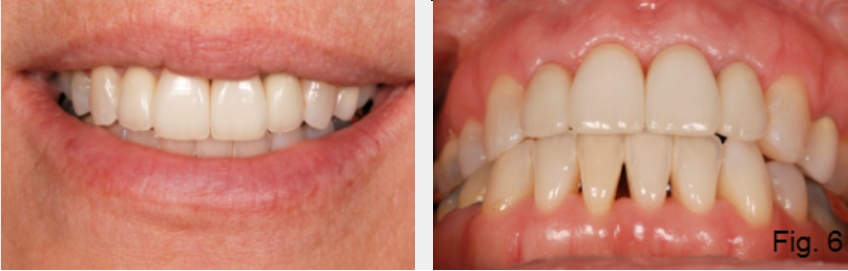 A Guide to Anterior Open Bites FrankSpear AnteriorOpenBites Fig.6C