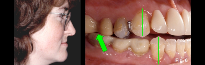 A Guide to Anterior Open Bites FrankSpear AnteriorOpenBites Fig.6E