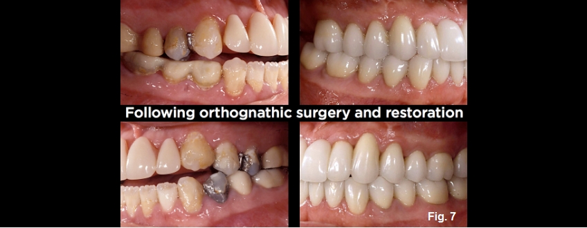 A Guide to Anterior Open Bites FrankSpear AnteriorOpenBites Fig.7E
