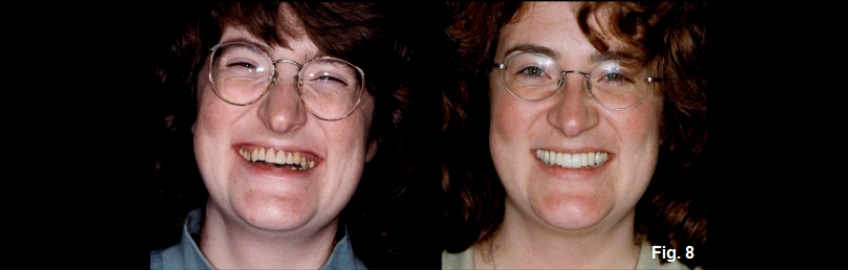 A Guide to Anterior Open Bites FrankSpear AnteriorOpenBites Fig.8E