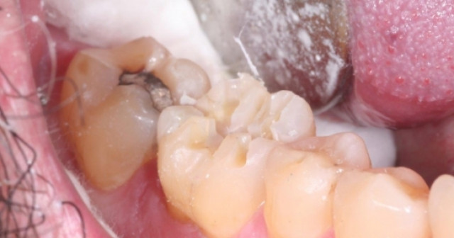 10 Steps to Posterior Crown Prep