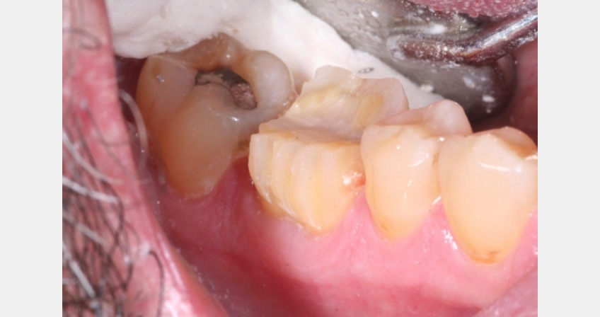 10 Steps to Posterior Crown Prep JeffLineberry 10 steps to posterior crown prep Fig.3 1