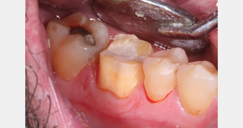 10 Steps to Posterior Crown Prep JeffLineberry 10 steps to posterior crown prep Fig.4