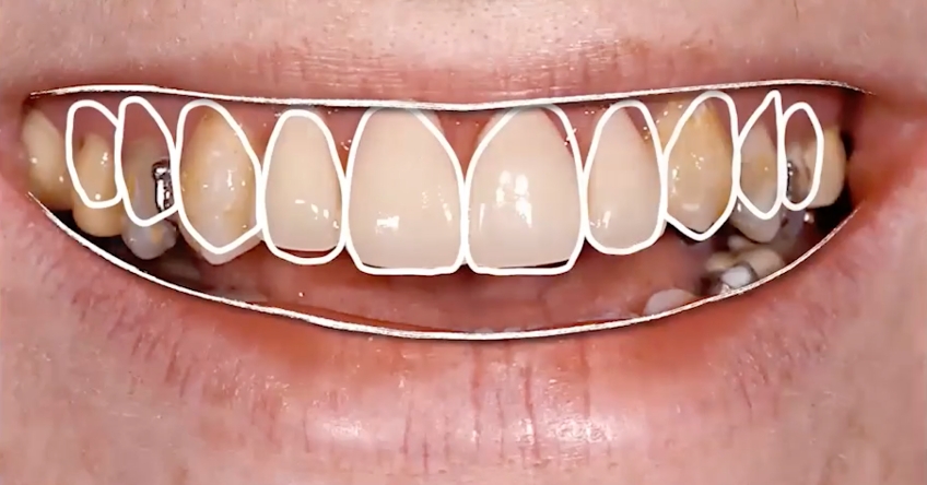 Advanced FGTP: The Inclusion of Airway Prosthodontics JeffreyRouse advanced fgtp airway prosthodontics Fig.2