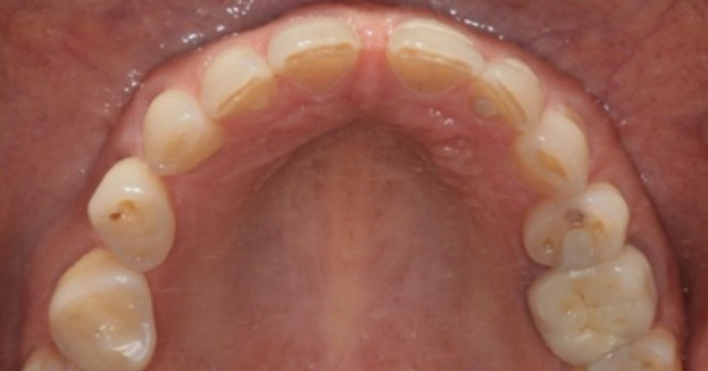 Occlusal view of a narrow maxillary arch illustrating skeletal limitations in maxilla-first treatment planning