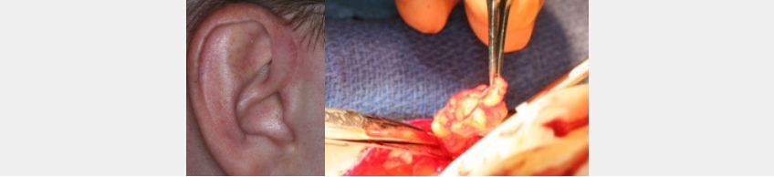 Autogenous Fat: Preferred Material for TMJ Disk Replacement Mckee autogenous fat preferred material 01