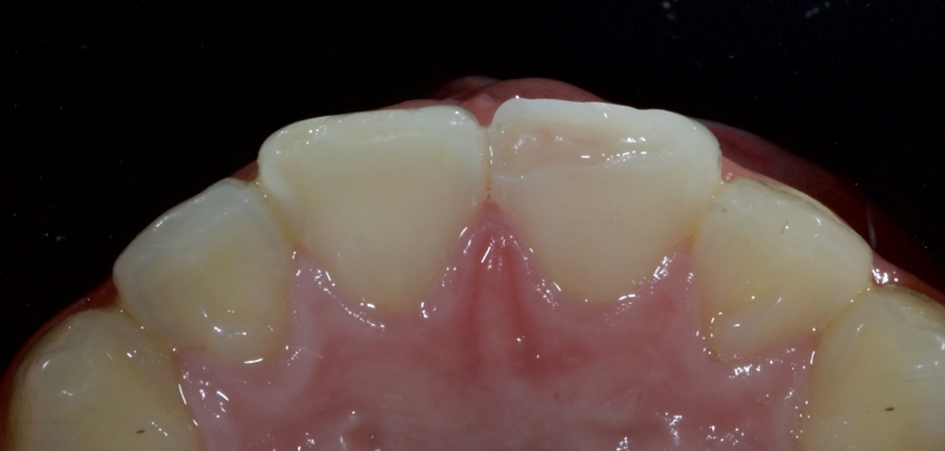 Management of Uncomplicated Crown Fractures in the Permanent Dentition Smithson management uncomplicated crown 02