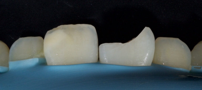 Management of Uncomplicated Crown Fractures in the Permanent Dentition Smithson management uncomplicated crown 04