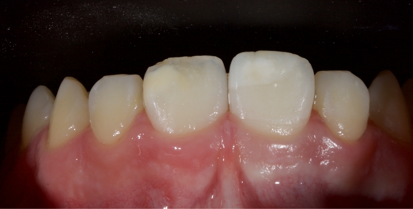 Management of Uncomplicated Crown Fractures in the Permanent Dentition Smithson management uncomplicated crown 05