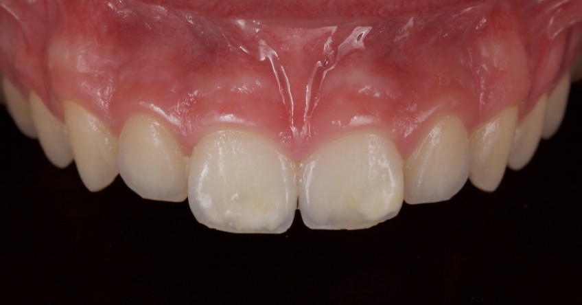 Management of Uncomplicated Crown Fractures in the Permanent Dentition Smithson management uncomplicated crown 06