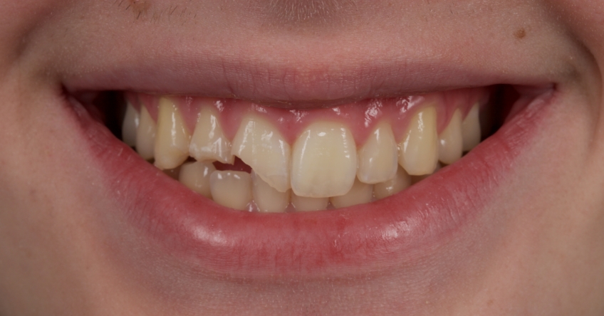 Management of Uncomplicated Crown Fractures in the Permanent Dentition Smithson management uncomplicated crown 07
