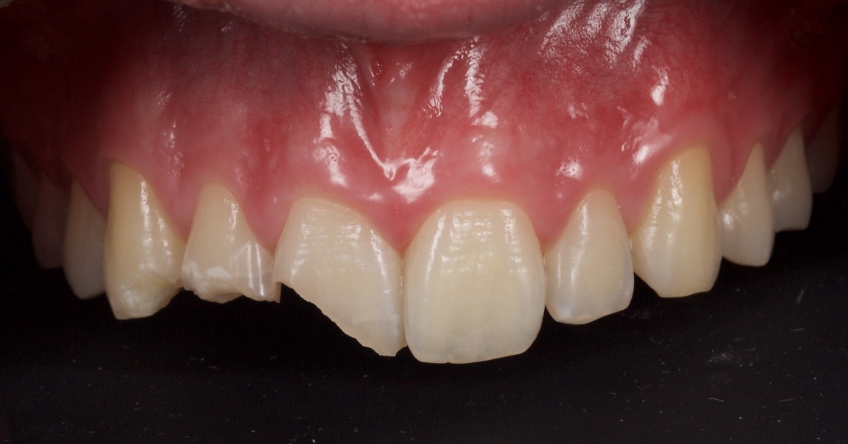 Management of Uncomplicated Crown Fractures in the Permanent Dentition Smithson management uncomplicated crown 09