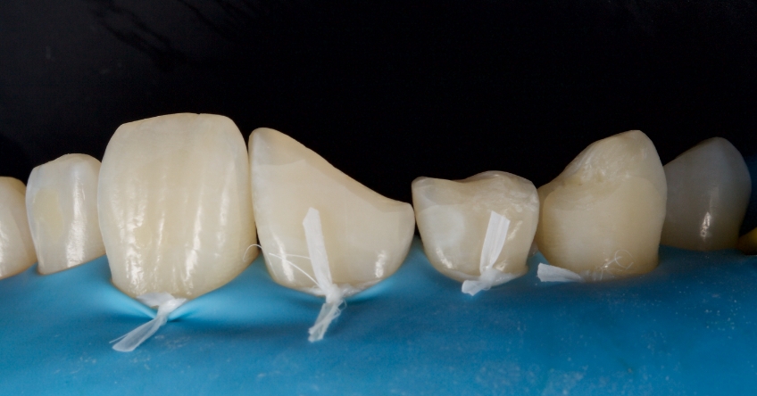Management of Uncomplicated Crown Fractures in the Permanent Dentition Smithson management uncomplicated crown 10