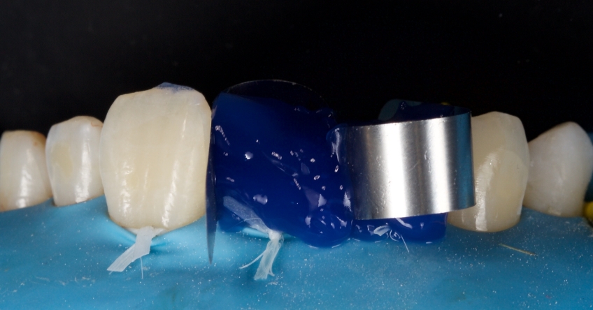 Management of Uncomplicated Crown Fractures in the Permanent Dentition Smithson management uncomplicated crown 11