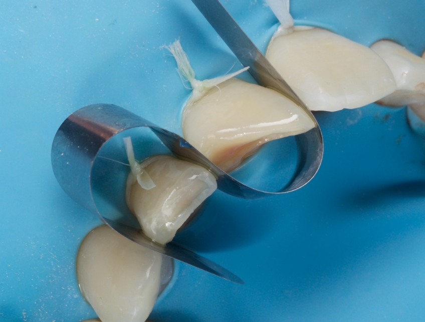Management of Uncomplicated Crown Fractures in the Permanent Dentition Smithson management uncomplicated crown 12