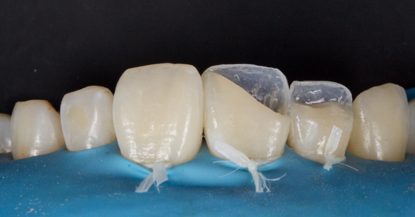 Management of Uncomplicated Crown Fractures in the Permanent Dentition Smithson management uncomplicated crown 13