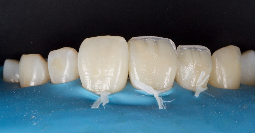 Management of Uncomplicated Crown Fractures in the Permanent Dentition Smithson management uncomplicated crown 14