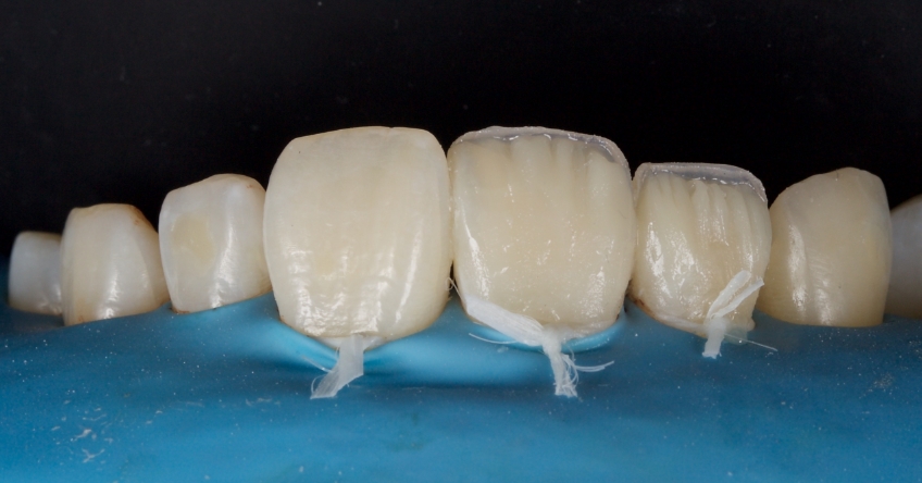 Management of Uncomplicated Crown Fractures in the Permanent Dentition Smithson management uncomplicated crown 15
