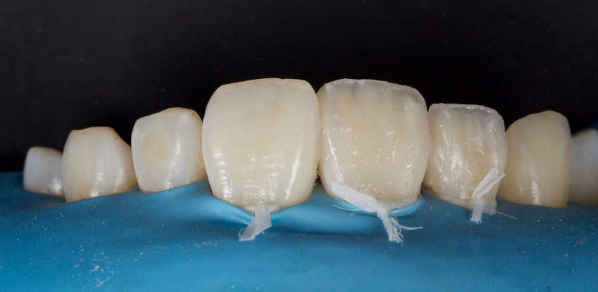 Management of Uncomplicated Crown Fractures in the Permanent Dentition Smithson management uncomplicated crown 16