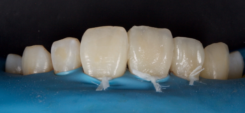 Management of Uncomplicated Crown Fractures in the Permanent Dentition Smithson management uncomplicated crown 17