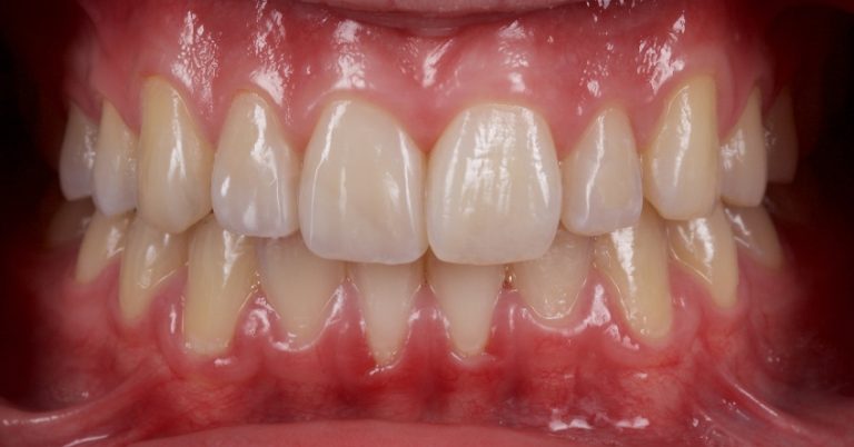 Management of Uncomplicated Crown Fractures in the Permanent Dentition