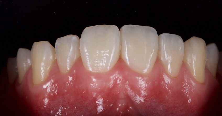 Management of Uncomplicated Crown Fractures in the Permanent Dentition Smithson management uncomplicated crown 19