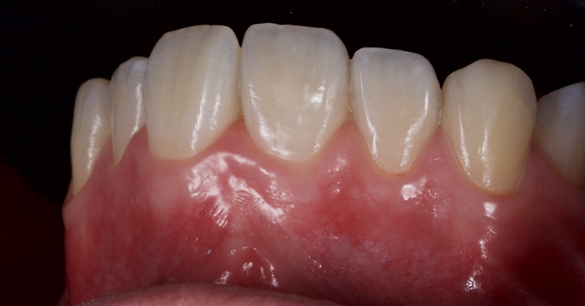 Management of Uncomplicated Crown Fractures in the Permanent Dentition Smithson management uncomplicated crown 20