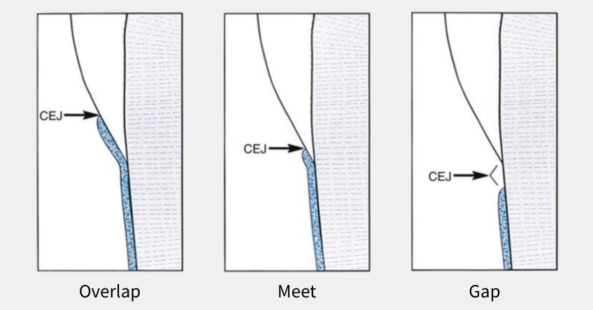 Three Keys to Ceramic Dental Adhesion: Enamel, Dentin, and Cementum Variations Bonk three keys ceramic dental adhesion 02