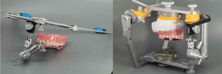 Clinical Remount Procedure: A Visual Guide DarinDichter ClinicaRemountProcd Fig.10