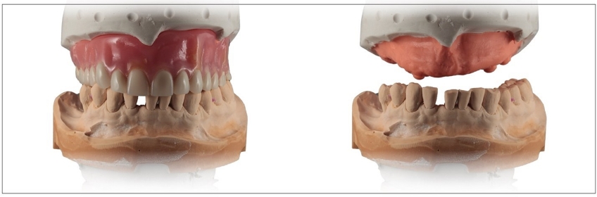 Clinical Remount Procedure: A Visual Guide DarinDichter ClinicaRemountProcd Fig.3