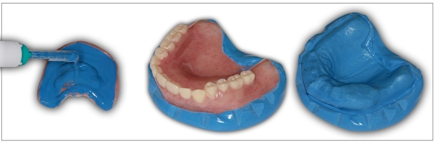 Clinical Remount Procedure: A Visual Guide DarinDichter ClinicaRemountProcd Fig.5