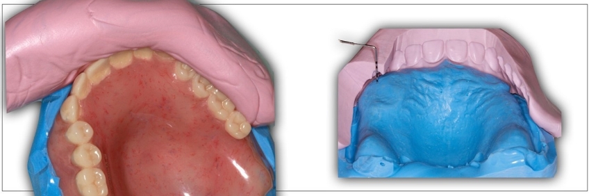 Clinical Remount Procedure: A Visual Guide DarinDichter ClinicaRemountProcd Fig.6