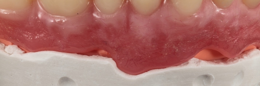 Clinical Remount Procedure: A Visual Guide DarinDichter ClinicaRemountProcd Fig.8
