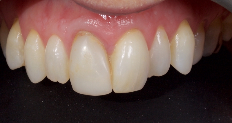 Advantages of Direct Composite Resin Veneers When Masking Tooth Discoloration Restorations Smithson advantages direct composite resin veneers 02