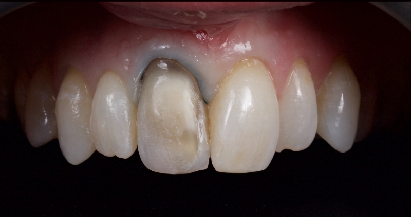 Advantages of Direct Composite Resin Veneers When Masking Tooth Discoloration Restorations Smithson advantages direct composite resin veneers 03