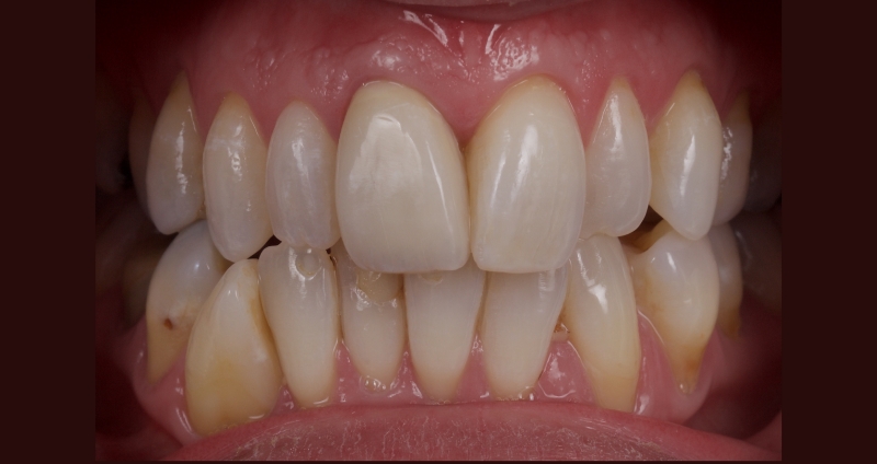 Advantages of Direct Composite Resin Veneers When Masking Tooth Discoloration Restorations Smithson advantages direct composite resin veneers 04
