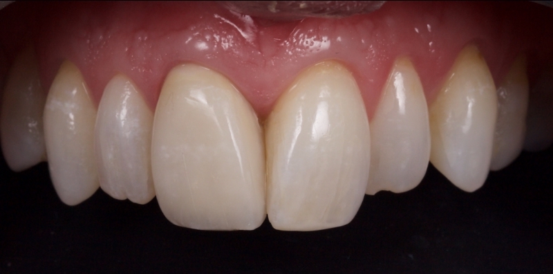 Advantages of Direct Composite Resin Veneers When Masking Tooth Discoloration Restorations Smithson advantages direct composite resin veneers 05