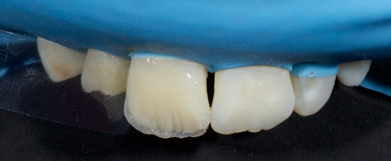 Advantages of Direct Composite Resin Veneers When Masking Tooth Discoloration Restorations Smithson advantages direct composite resin veneers 06