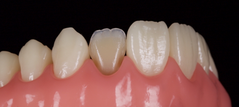 Advantages of Direct Composite Resin Veneers When Masking Tooth Discoloration Restorations Smithson advantages direct composite resin veneers 07