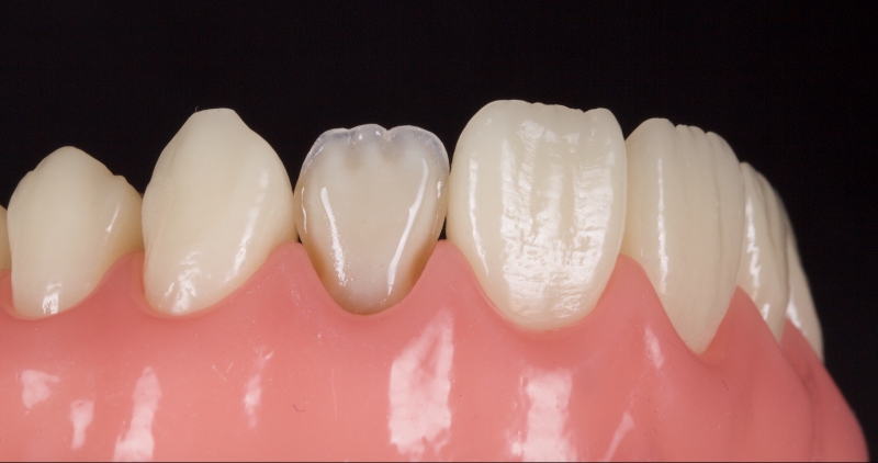 Advantages of Direct Composite Resin Veneers When Masking Tooth Discoloration Restorations Smithson advantages direct composite resin veneers 09
