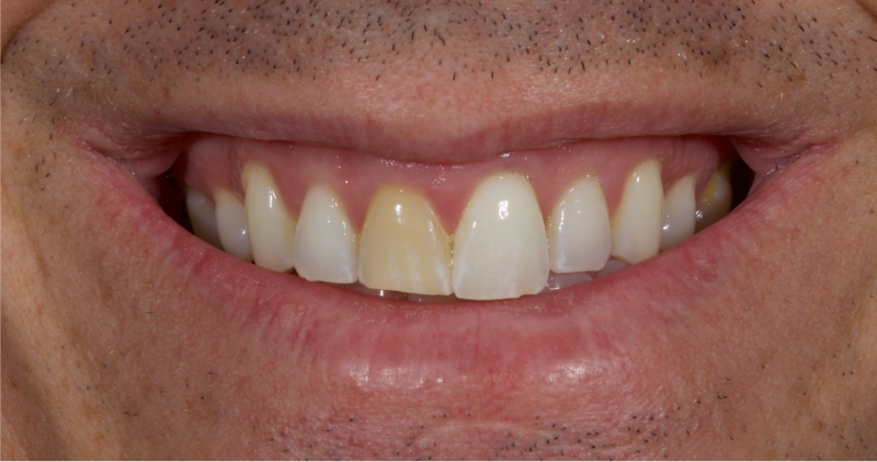 Advantages of Direct Composite Resin Veneers When Masking Tooth Discoloration Restorations Smithson advantages direct composite resin veneers 10