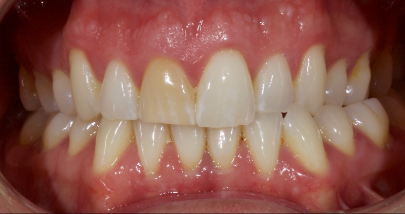 Advantages of Direct Composite Resin Veneers When Masking Tooth Discoloration Restorations Smithson advantages direct composite resin veneers 11