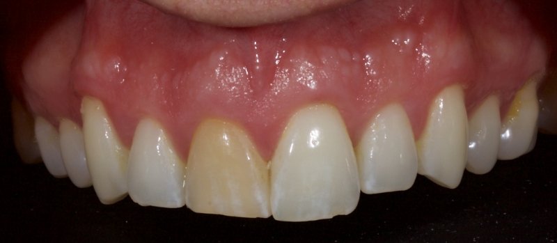 Advantages of Direct Composite Resin Veneers When Masking Tooth Discoloration Restorations Smithson advantages direct composite resin veneers 12