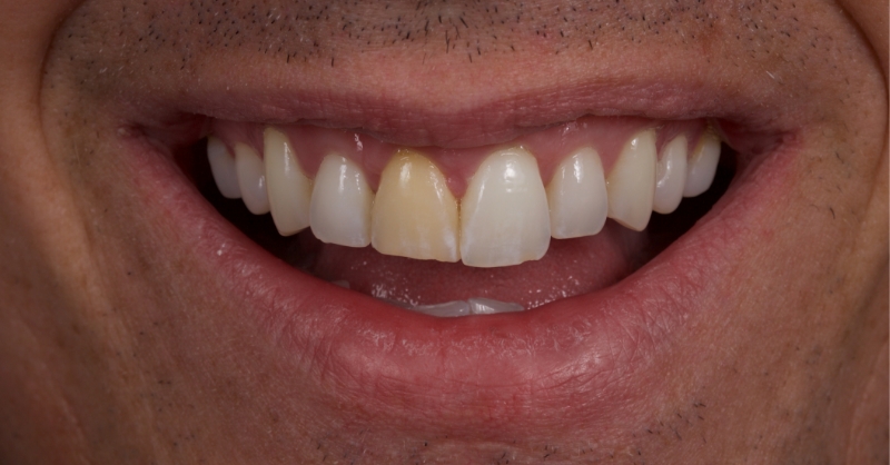 Advantages of Direct Composite Resin Veneers When Masking Tooth Discoloration Restorations Smithson advantages direct composite resin veneers 13