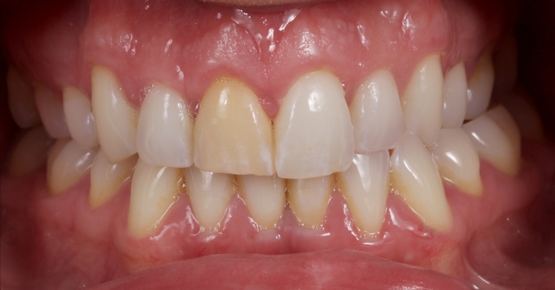 Advantages of Direct Composite Resin Veneers When Masking Tooth Discoloration Restorations Smithson advantages direct composite resin veneers 14