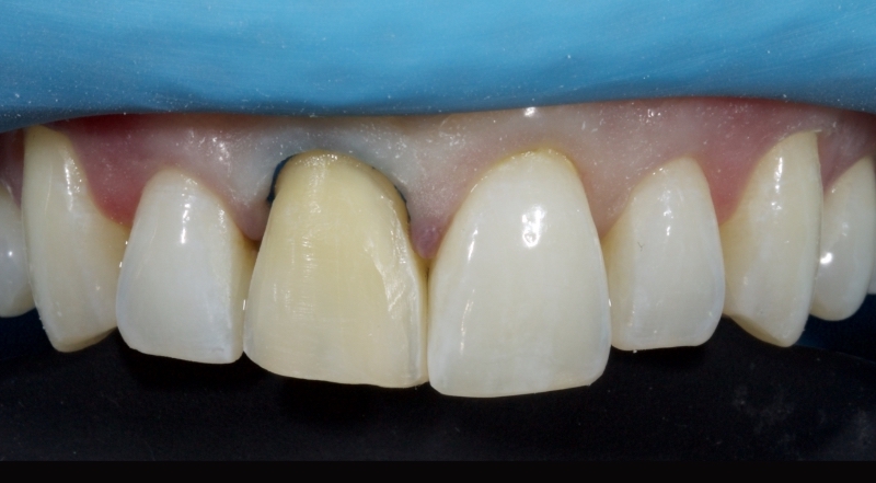 Advantages of Direct Composite Resin Veneers When Masking Tooth Discoloration Restorations Smithson advantages direct composite resin veneers 15