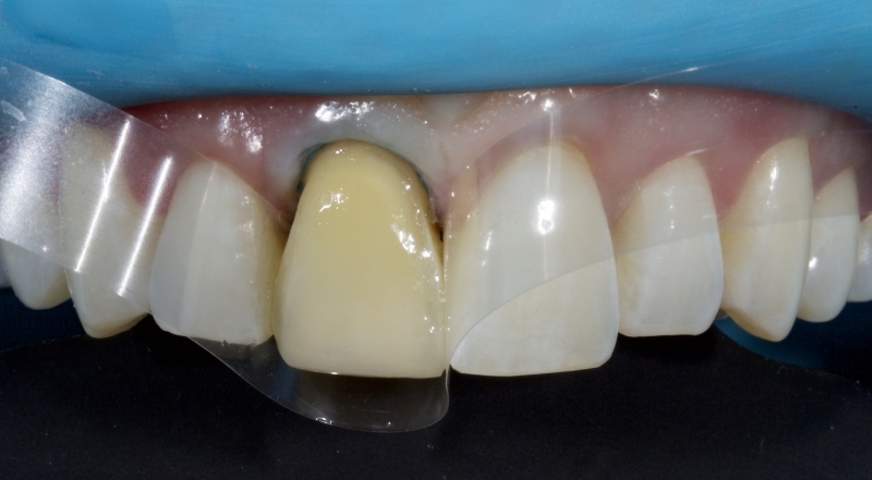 Advantages of Direct Composite Resin Veneers When Masking Tooth Discoloration Restorations Smithson advantages direct composite resin veneers 16