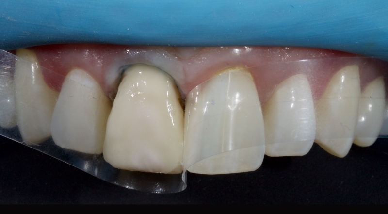 Advantages of Direct Composite Resin Veneers When Masking Tooth Discoloration Restorations Smithson advantages direct composite resin veneers 17