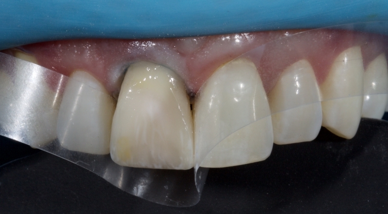 Advantages of Direct Composite Resin Veneers When Masking Tooth Discoloration Restorations Smithson advantages direct composite resin veneers 18